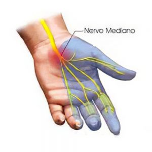 ant_Sindrome_del_tunnel_carpale_parte_2