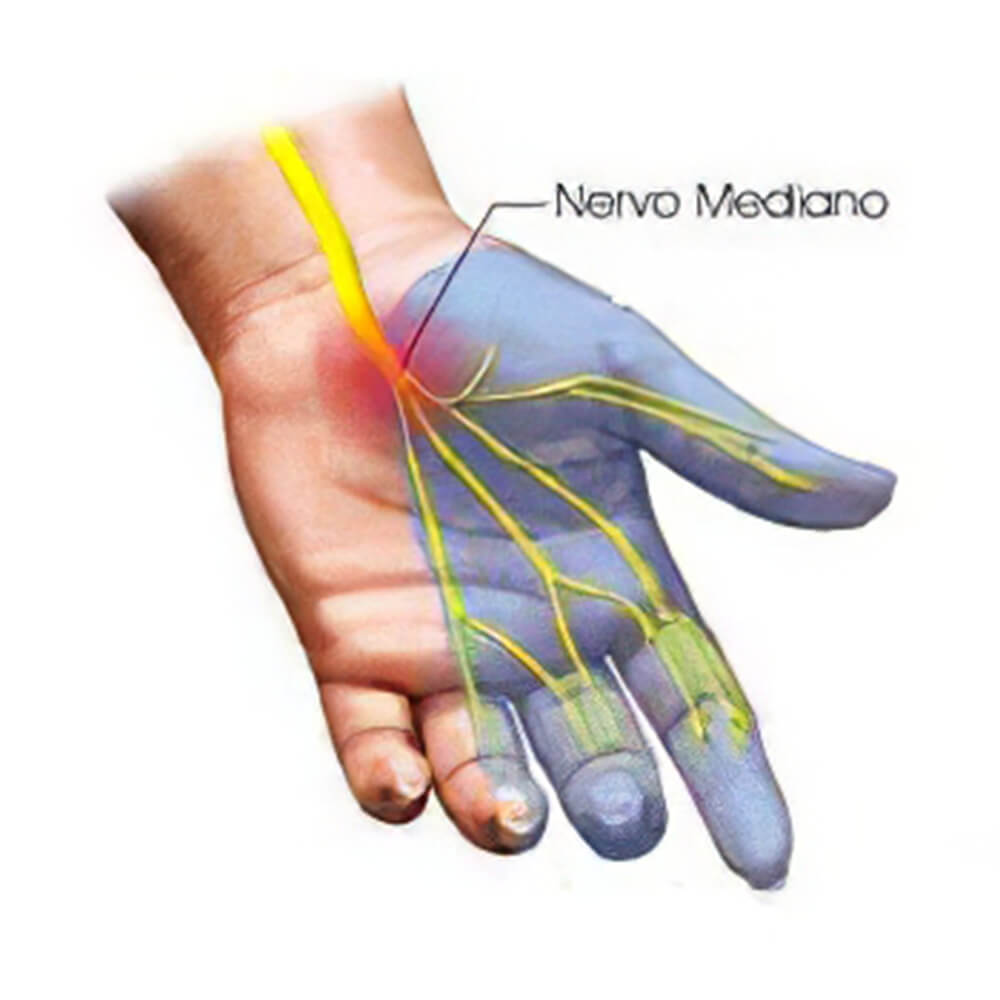 ant_Sindrome_del_tunnel_carpale_parte_2