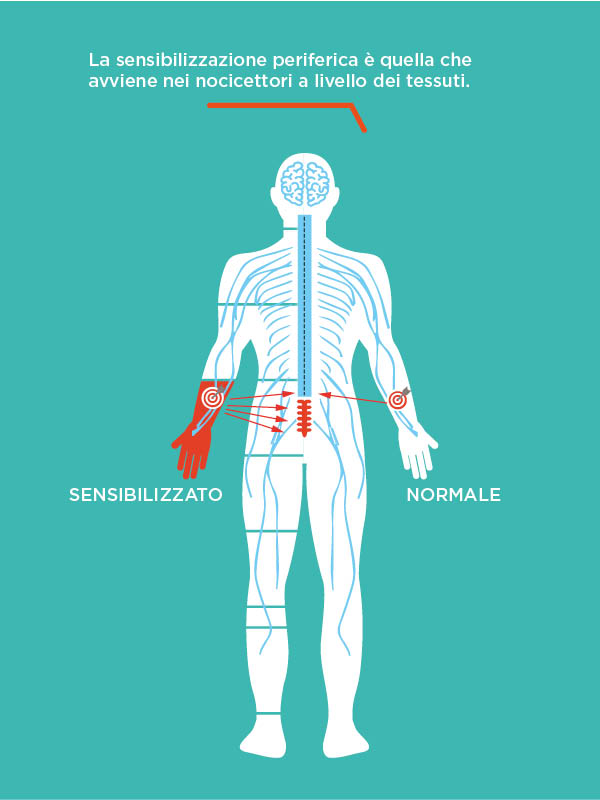 Figura 1 Sensibilizzazione del sistema nervoso